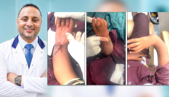 إنجاز طبي غير مسبوق.. جراح يمني في عدن ينهي معاناة طفل من تشوه خلقي معقد بعد 13 عاماً من المعاناة